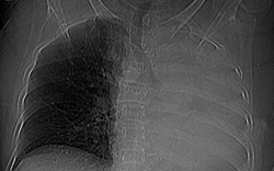 Sặc một viên thuốc, cụ bà xẹp toàn bộ phổi trái