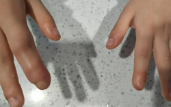 Trẻ hay cắn móng tay? Cẩn thận “cắn” ra vấn đề nghiêm trọng, bố mẹ đừng chủ quan!