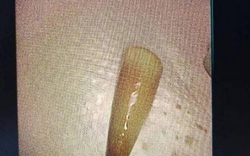 Người đàn ông liên tục ho ra máu, bác sĩ lấy ra thứ "đáng sợ" trong phổi