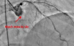 Chết lâm sàng vì bỏ qua dấu hiệu cảnh báo nhồi máu cơ tim cấp