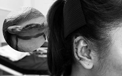 Hành trình tìm lại diện mạo cho người bệnh bị mất vành tai