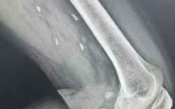 Thói quen nhiều người Việt mê mẩn khiến sán “làm tổ” dưới da mà không hay biết