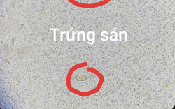 Đau bụng đi khám, người đàn ông 64 tuổi sốc ngang khi thấy ở sán trong người