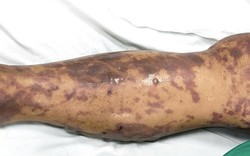 Sau khi ăn 1 loại thịt, người đàn ông 52 tuổi mắc phải bệnh truyền nhiễm nguy hiểm, lây lan nhanh và nguy cơ tử vong cao