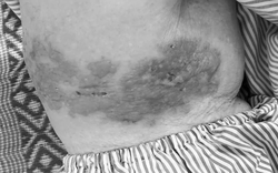 Đắp thuốc nam chữa zona thần kinh: Nguy cơ nhiễm trùng da nặng