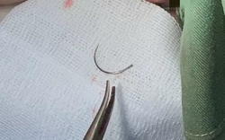 Kim khâu bị ‘bỏ quên’ trong cơ thể người phụ nữ suốt 11 năm