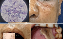 Nấm đen xâm lấn não: Bệnh hiếm nhưng cực kỳ nguy hiểm