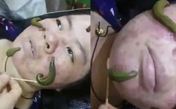 Ớn lạnh dùng đỉa hút mụn, bác sĩ cảnh báo hiểm họa