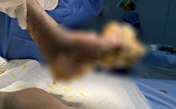 Người đàn ông suýt mất cả bàn chân vì nhiễm HPV