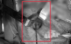 Nấm đen ăn mòn xoang hàm người đàn ông khỏe mạnh