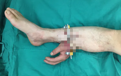 Bác sĩ cứu bàn tay bị đứt lìa của người bệnh bằng cách ghép vào chân