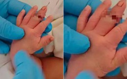 Trẻ sơ sinh bị đứt ngón tay khi nữ hộ sinh tiến hành cắt dây rốn