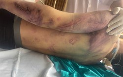 Bộ Y tế yêu cầu rà soát các cơ sở trợ giúp xã hội sau vụ học viên tử vong ở Quảng Ninh