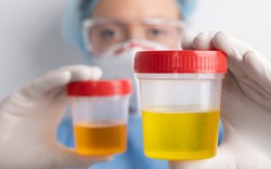 Hướng dẫn phân biệt màu nước tiểu khi thận suy?