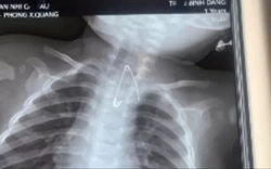 Trẻ bị thủng tá tràng vì nuốt que kẹo mút