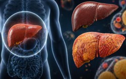 1 loại thực phẩm có thể hại gan hơn cả rượu bia nếu tiêu thụ quá nhiều: Thích đến mấy cũng phải hạn chế