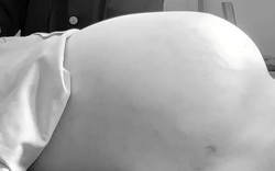Cảnh báo bướu buồng trứng ở trẻ từ dấu hiệu bụng to nhanh