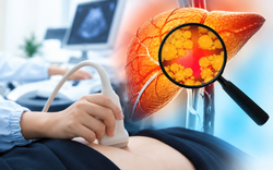 Chăm tập thể dục, kiêng chất béo nhưng gan vẫn nhiễm mỡ: Bác sĩ Bạch Mai chỉ ra nguyên nhân