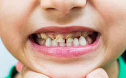 Bé trai 10 tuổi xuất huyết não nghiêm trọng sau khi tự nhổ răng sâu, bác sĩ cảnh báo cha mẹ