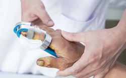 Bỏng nặng do điện thoại phát nổ khi đang sạc