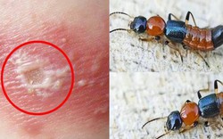 Kiến ba khoang "vào mùa", cẩn trọng dễ nhầm với zona thần kinh
