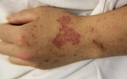 Con mắc não mô cầu, người mẹ mới nghĩ đến chuyện tiêm vaccine