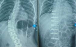 Việt Nam lần đầu tiên phẫu thuật nắn chỉnh vẹo cột sống không ghép xương: Cột sống bé gái thẳng tắp sau ca mổ chưa từng có