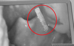 Bé trai gần 4 tuổi khó chịu ở cổ, bố mẹ kinh ngạc khi bác sĩ gắp ra thứ "đáng sợ" bên trong