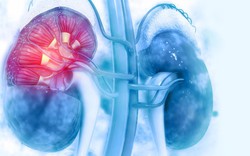 Chuyên gia Mỹ: Đây là dấu hiệu đầu tiên của bệnh thận, chớ nên bỏ qua