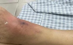 Liên tiếp các trường hợp rết cắn phải nhập viện