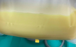 Người phụ nữ 32 tuổi máu "trắng đục như sữa", bác sĩ "chỉ mặt điểm tên" thói quen ít ai ngờ