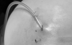 Thận trọng khi tiêm filler vào cơ thể