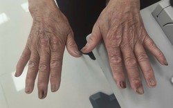 Móng tay dài, cặn bẩn đầy kẽ khiến người phụ nữ loét giác mạc