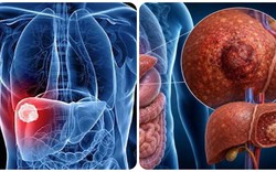 9 triệu chứng ung thư gan giai đoạn đầu