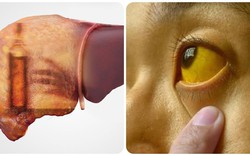 4 dấu hiệu ung thư gan giai đoạn cuối