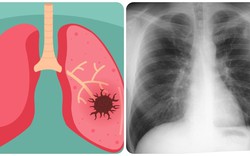 9 dấu hiệu ung thư phổi giai đoạn đầu