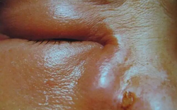 Sáng ngủ dậy nước mắt “dính như keo”, người phụ nữ đi khám phát hiện điều bất ngờ