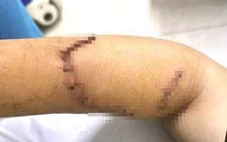 Sức khỏe nữ sinh lớp 9 bị bạn dùng dao tấn công gây đa thương tích ở Đắk Lắk