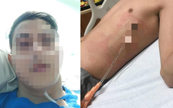 Chỉ vươn vai buổi sáng, nam sinh 17 tuổi bị “xẹp phổi”