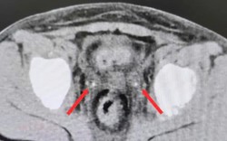 Cực kỳ hiếm: Sỏi niệu quản kẹt hai bên sau mổ viêm ruột thừa khiến bệnh nhi suy thận cấp