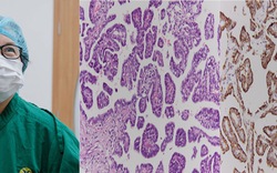 Đi khám viêm dạ dày, phát hiện ung thư phổi hiếm gặp