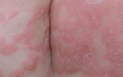 Bé trai 3 tuổi bị giang mai bẩm sinh dù không có triệu chứng