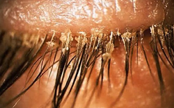 Người phụ nữ 24 tuổi khó chịu ở mí mắt, bác sĩ sốc khi gắp ra thứ "đáng sợ" chi chít trên mi