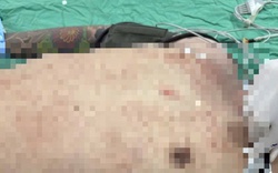 Cứu sống 1 nam bệnh nhân nguy kịch do thủng tim