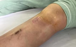 Dọn nhà đón Tết, phòng ngừa chấn thương khớp