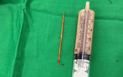 Người đàn ông bụng "cứng như đá" 2 tuần, bác sĩ phát hiện nguyên nhân bất ngờ