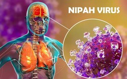 Thêm ca mắc mới và tử vong do Nipah, Bộ Y tế cảnh báo: "Virus Nipah có tiềm năng gây đại dịch"