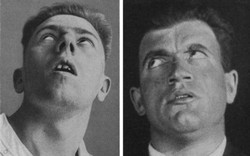 Căn bệnh kỳ lạ đã giết chết 500.000 người rồi đột ngột biến mất