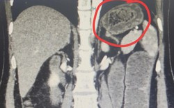 Nguy hiểm: Tắc ruột do bã thức ăn