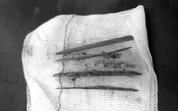 Nuốt 3 cây tăm, nữ bệnh nhân phải mổ cấp cứu